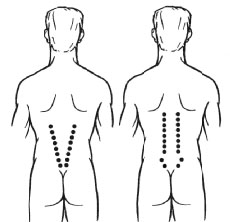 脊椎神経根炎、腰痛、ぎっくり腰の電磁リフレクソロジークリトン-K装着例